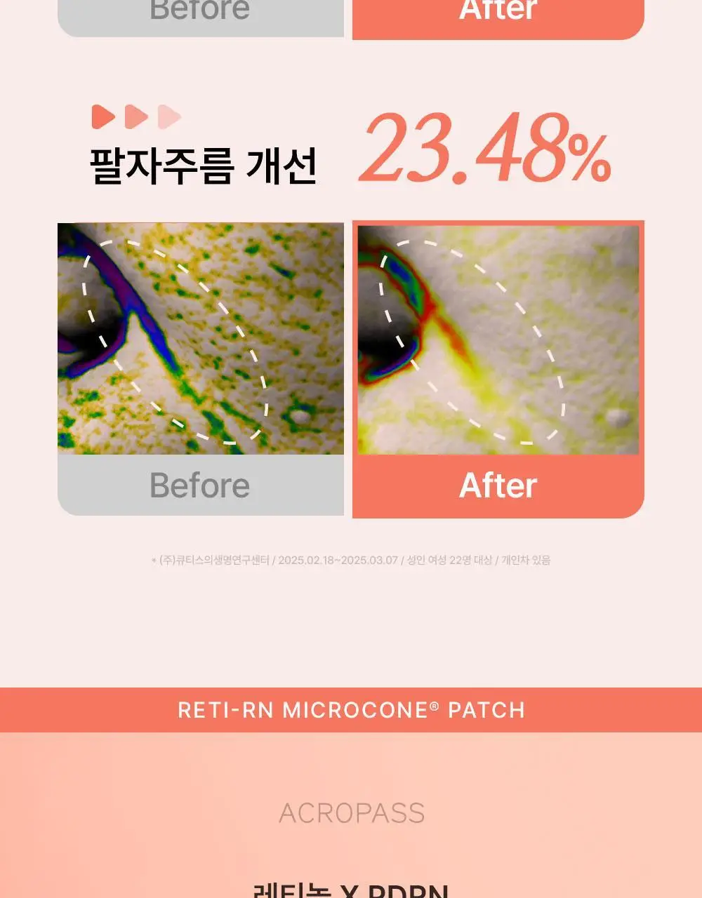[주름패치]아크로패스 레티알엔 마이크로콘 패치 (미간/눈가팔자 중 택1) 상세페이지 3